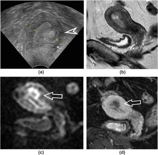 Transvaginal Ultrasound or MRI: Which is More Effective in Evaluating Endometrial Cancer?