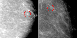 Cancer Recurrence in Autologous Reconstructed Breast
