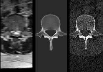 FDA Clears AI-Powered Platform for Converting Spine MRIs to 3D Visualizations