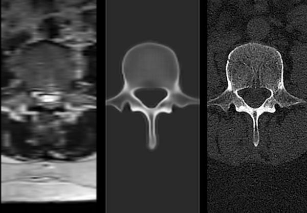 FDA Clears AI-Powered Platform for Converting Spine MRIs to 3D Visualizations