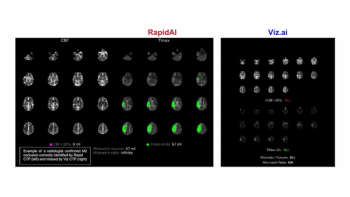 CT Perfusion Study Shows Enhanced Detection of Medium Vessel Occlusions with Emerging AI Software