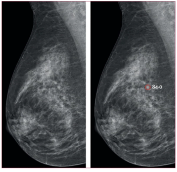 Study: Mammography AI Leads to 29 Percent Increase in Breast Cancer Detection