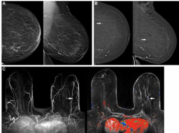 Can Contrast-Enhanced Mammography Enhance Early Detection in Patients with Prior Breast Cancer History?