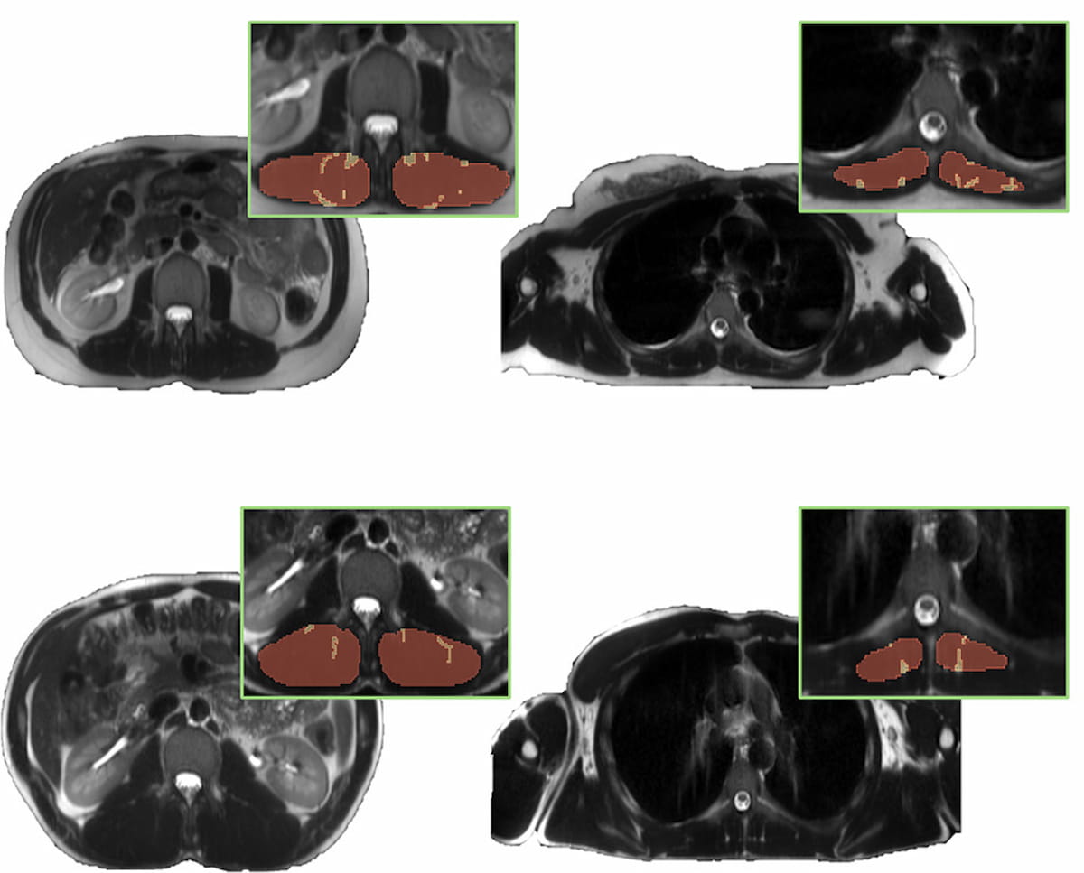 Whole-Body MRI Study Shows Impact of Adipose Tissue and Lean Muscle Mass on Cardiometabolic Risk Factors
