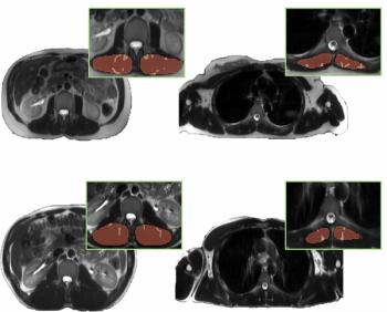 Whole-Body MRI Study Shows Impact of Adipose Tissue and Lean Muscle Mass on Cardiometabolic Risk Factors