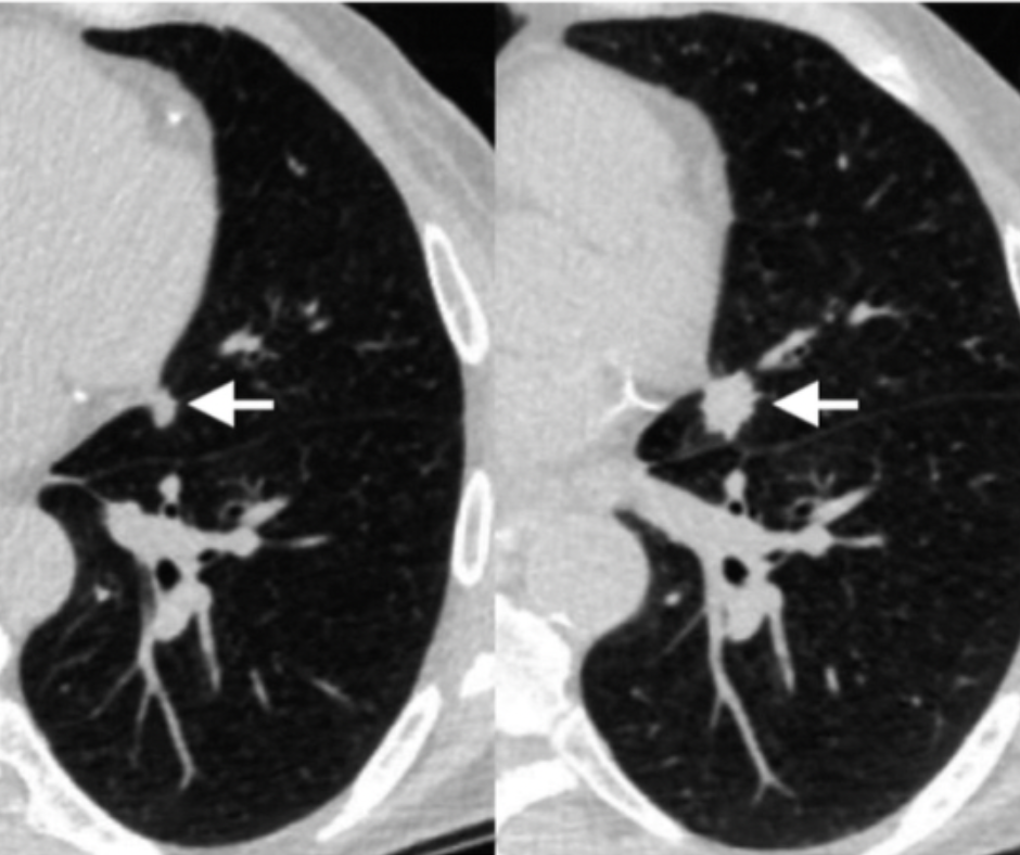 Deep learning models may predict lung cancer risk from a single CT scan