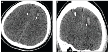 What a Prospective CT Study Reveals About Adjunctive AI for Triage of Intracranial Hemorrhages