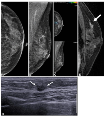 Mammography Study Reveals Mixed Results with Standalone AI Assessment for Post-Mastectomy Surveillance