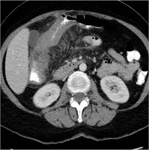 Adenocarcinoma