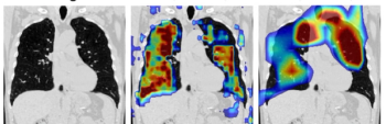 Can AI Facilitate Single-Phase CT Acquisition for COPD Diagnosis and Staging?