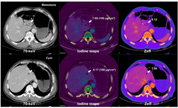 Can AI-Powered Image Reconstruction Facilitate Lower Radiation Dosing with Dual-Energy CT Detection of Liver Metastases?