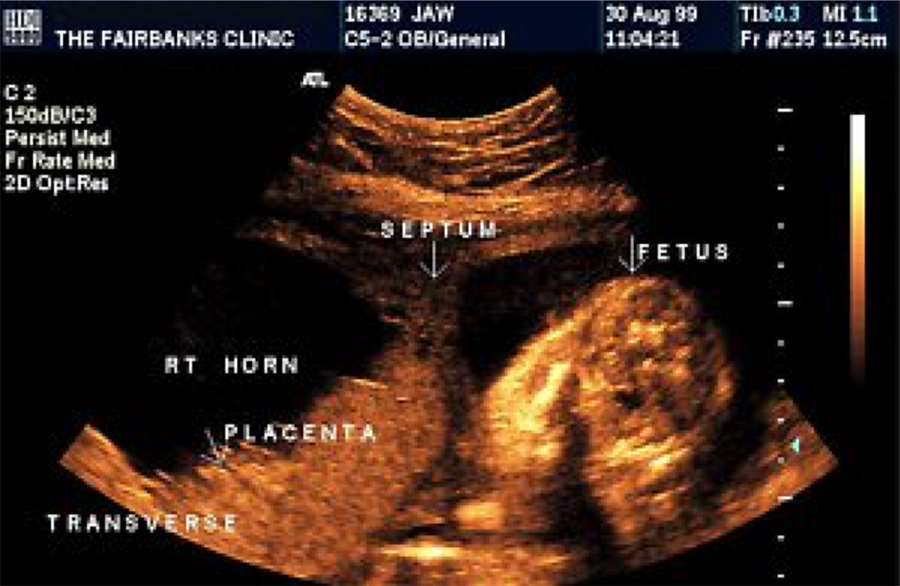 Recognizing Intraamniotic Bandlike Structures on Obstetric Ultrasound