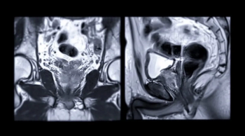 Is PI-RADS Version 2.1 Outdated for Prostate MRI?