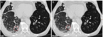 Photon Counting CT Facilitates Tenfold Reduction in Radiation Dosing for Detecting Post-Transplant Lung Deformities