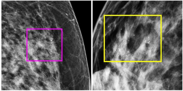 Study: Radiomic Mammography Features Lead to Upstaging of DCIS in More than 14 Percent of Patients