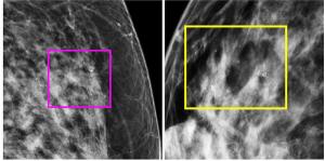 Study: Radiomic Mammography Features Lead to Upstaging of DCIS in More than 14 Percent of Patients