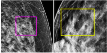 Study: Radiomic Mammography Features Lead to Upstaging of DCIS in More than 14 Percent of Patients
