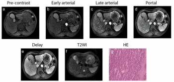 MRI Study at ARRS Raises Questions About Disparities in Detection of MASLD
