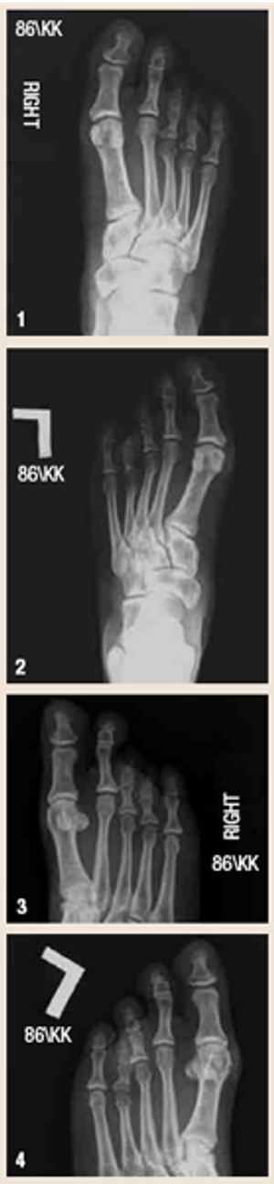Bilateral brachymetapody