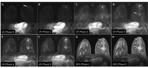 What New Prospective Research Reveals About Ultrafast Breast MRI
