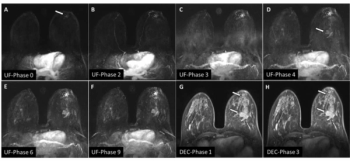 What New Prospective Research Reveals About Ultrafast Breast MRI