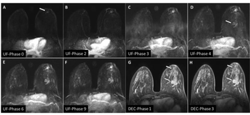What New Prospective Research Reveals About Ultrafast Breast MRI