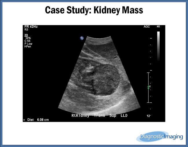 Kidney Mass kidney-mass