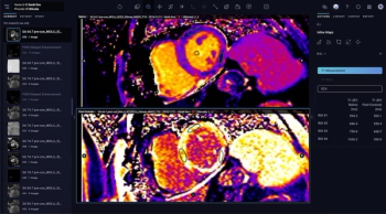  FDA Clears Updated AI Software for Generating Inline Mapping with Cardiac MRI