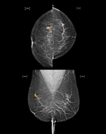 Can an Emerging AI Platform Enhance Real-Time Results for Mammography?