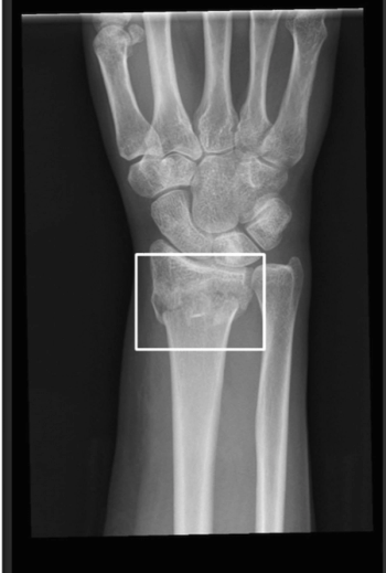 AI Facilitates Nearly 83 Percent Improvement in Turnaround Time for Fracture X-Rays