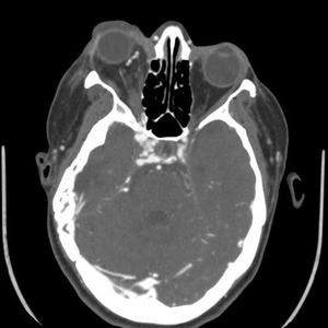 Orbital Arteriovenous Fistula