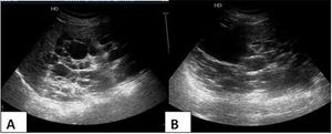 Autosomal Dominant Polycystic Kidney Disease