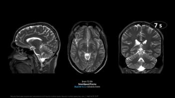 FDA Clears SmartSpeed Precise MRI Software from Philips