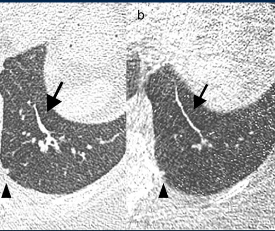Can Ultra-Low-Dose CT be Effective for Lung Cancer Screening in Current or Past Smokers? - Diagnostic Imaging