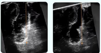 SonoClear System Gets FDA Breakthrough Device Designation for Enhancing Ultrasound-Guided Brain Tumor Resection