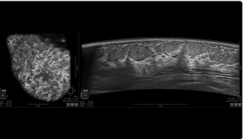 GE HealthCare Unveils AI-Powered 3D Ultrasound System for Dense Breasts