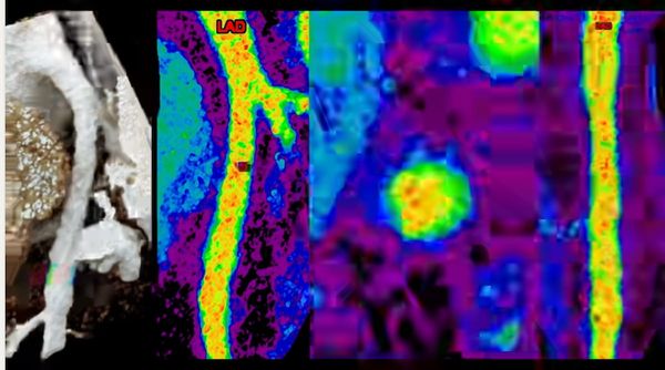 Early Intervention for Coronary Artery Disease and the Role of Photon-Counting CT