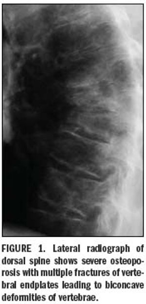 Imaging tools transform diagnosis of osteoporosis