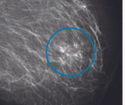 Can AI-Powered Mammography Screening be a Game Changer?