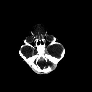 Congenital Marked Communicated Hydrocephalus