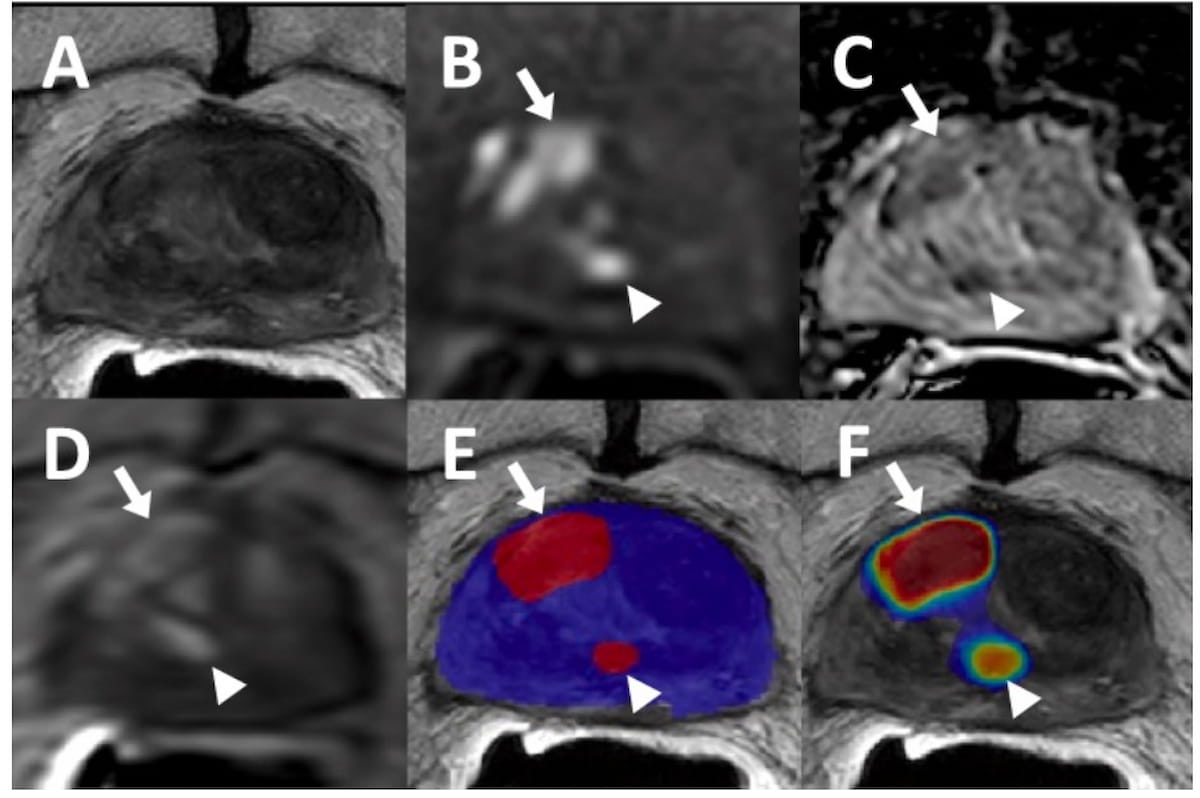 Can a Deep Learning Algorithm Enhance Detection of Prostate Cancer ...