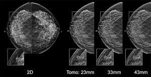 AI for Digital Breast Tomosynthesis Enhances Diagnostic Performance 