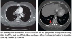 Small pulmonary emboli still stump radiologists