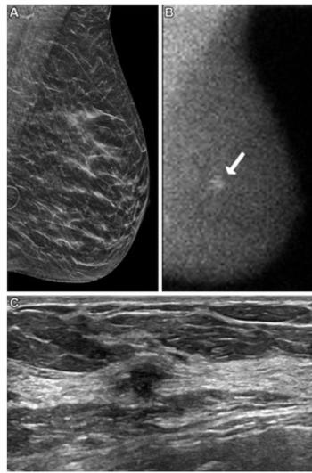 Can Supplemental Molecular Breast Imaging Enhance Breast Cancer Detection in Women with Dense Breasts?