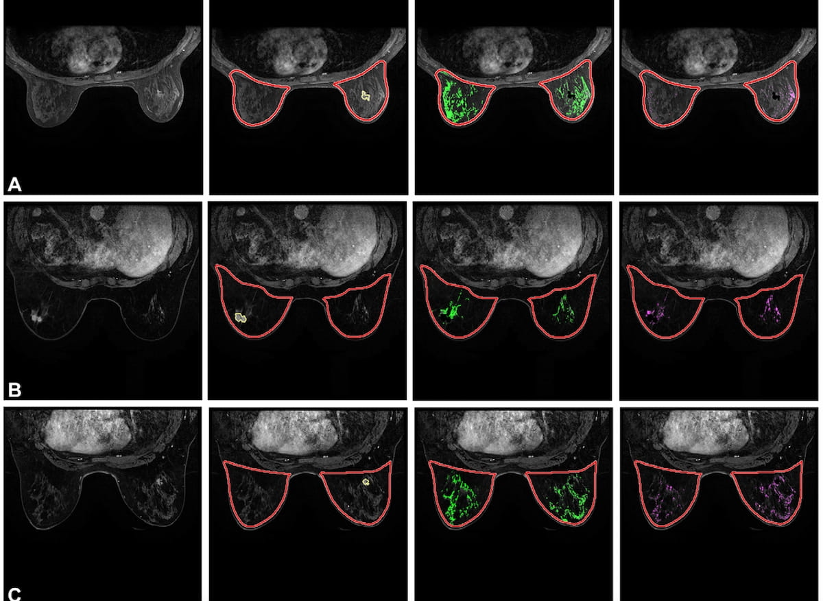 Study Shows BPE Quantification on MRI Helps Predict Risk of Breast Cancer Recurrence