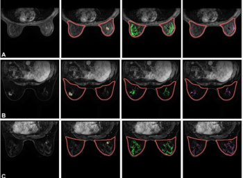 Study Shows BPE Quantification on MRI Helps Predict Risk of Breast Cancer Recurrence