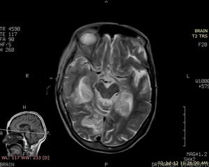Herpes Simplex Encephalitis
