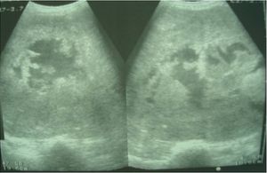 Biliary Cystadenocarcinoma
