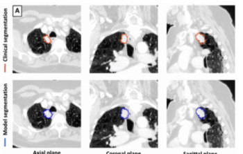 Study: CT-Based AI Offers Enhanced Sensitivity and Reduced Segmentation Time for Lung Tumors