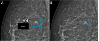 Use of Mammography AI Leads to 12 percent CDR Increase and 20 Percent Decrease in Recall Rate